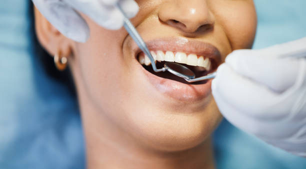 Best Emergency Wisdom Teeth Removal in Cary, IL