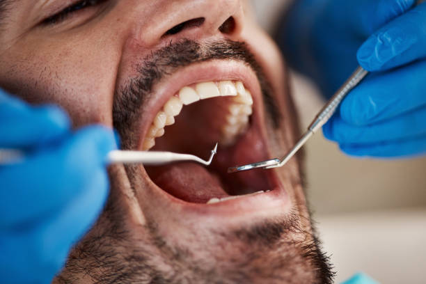 Best Emergency Wisdom Teeth Removal in Cary, IL